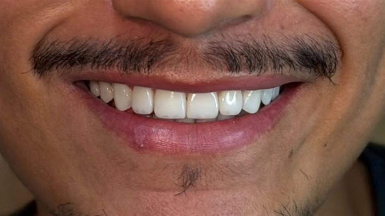 Depois do tratamento — caso 3, consultório Vinicius de Moraes